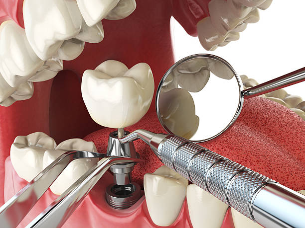 Best Lost Filling or Crown Replacement in Stratford, CA
